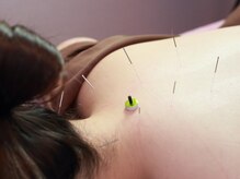 鍼灸ガジュマル/首肩コリへのアプローチ