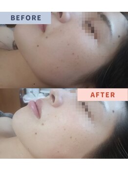 サンハート(SUN HEART)/フォト＋ヒト幹美容液＋美白P