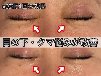 ヴィオール 名古屋栄店(VIOR)/目の下ギリギリまで照射☆