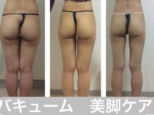 マッチ(much)/美脚にはバキューム