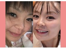 オーナーの大木はシミ・くすみ肌からピカピカ肌へ