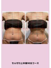 バベルトータルビューティー 北堀江店(Babel Total Beauty)/上半身コース〈Before/After〉