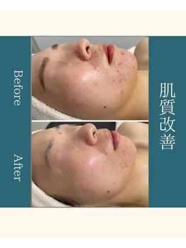 エステ大阪PON/肌質改善オーダーメイドface
