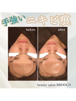 ブローチ 岡崎店(BROOCH)/活性ニキビ&ニキビ凹凸ケア