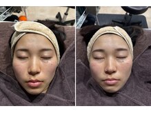 セントラル鍼灸院リラクシー(Re:laxy)/パルス美容鍼継続でこんなに驚愕