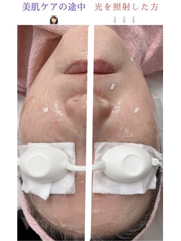 ランプシー(Lampsi)/光で小顔に！たるみ、シミケア