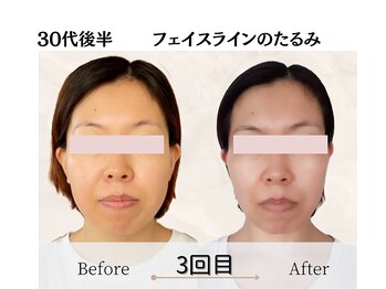 エミフル(emifull)/たるむとできる線が無くなった