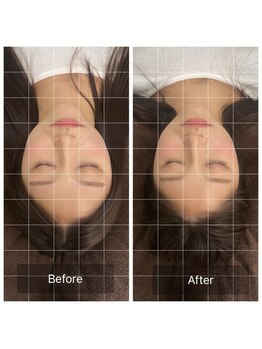 トニック バイ まつもと整骨院鍼灸院(Tonic)/★Before After★豊中/小顔