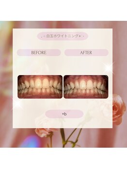 プラスビーセルフ(+b self)/ホワイトニングビフォーアフター