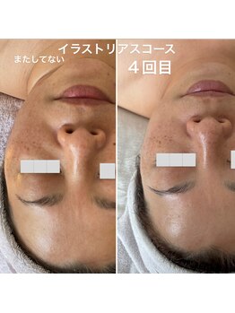 リュミエール(Lumie're)/美白ケア