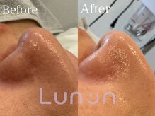 ルノン(Lunon)/毛穴洗浄ハイドロ