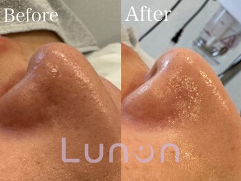 ルノン(Lunon)/毛穴洗浄ハイドロ