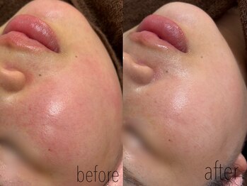 カノネ(Cannone')/赤ら顔 / 施術1回