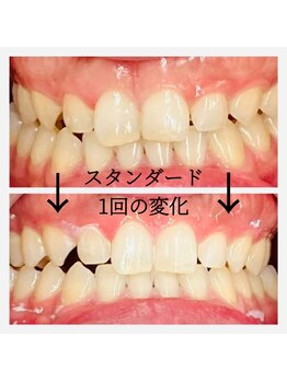 シエル(CIEL)/ビフォーアフター