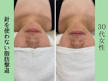 ソルニスクア(Solnis.qua)/小顔☆脂肪分解/ハイパーナイフ