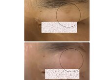サロン リノ(salon rino)の雰囲気(目の上のシミも諦めない!塗るだけ、新しいシミケア体験!)