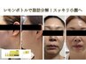 【二重顎改善・小顔ケア】脂肪分解レモンボトル+毛穴洗浄+パック or 美容液