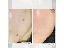 《ニキビケア》1ヶ月3回の効果です◎