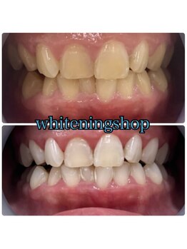 ホワイトニングショップ 和歌山店/Before&After美白ホワイトニング