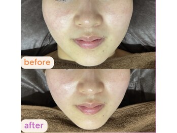 サクラ(SAKURA)/小顔矯正マッサージ♪