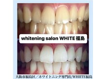 ホワイトニングサロン ホワイト(WHITE)/セルフホワイトニング/大阪/福島