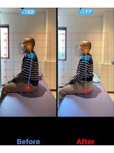 松戸駅前鍼灸院 整骨院/歪み/骨格矯正/猫背/姿勢改善