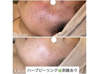 マドモアゼル 麻布十番/ハーブピーリング