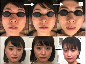 サロンチオリ 烏丸(Salon Chiori)の写真/施術歴累計1万人突破!希少な米国式小顔矯正で“老け見え”顔に速攻アプローチ！たるみ改善で小顔印象UP☆