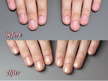 パズルリングネイル(Puzzle.ring Nail)/深爪矯正