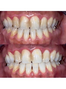 エール(aile)/うるま市セルフホワイトニング