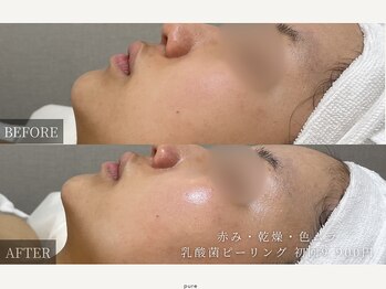 ピュア(pure)/ピーリング2回