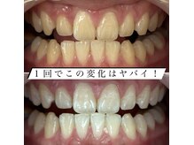 ヤット 森ノ宮(yatto.)の雰囲気(スペシャルホワイトニング1回で6~10トーンアップします!)