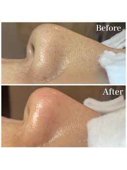 癒える(ielu)/毛穴エクストラクション