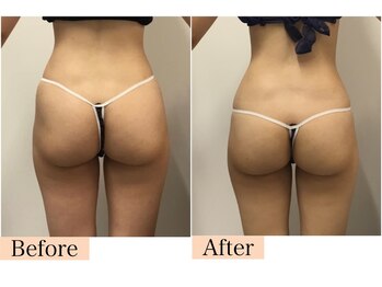 シャイニングビューティー 表参道(Shining Beauty)/ヒップアップ