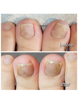 エヌ(enu.)/巻き爪ケア