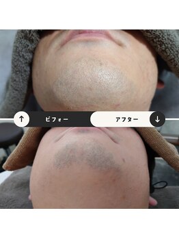 ジュゴン(Dugong)/ひげ脱毛（Before＆After）