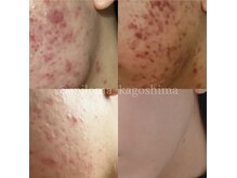 エピロマ(EPILOMA)の雰囲気（ニキビケア/肌質改善/肌育 トラブルのでないお肌へ育てます）