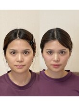 小顔22 ボルティ 赤坂支店(Bolty)/【悩み】顔の横幅