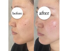 ブランカ(BLANCA)/エクソソーム水光導入