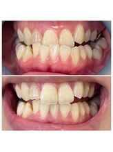 ウルト(ULT)/セルフホワイトニング