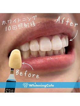 ホワイトニングカフェ 熊本店(WhiteningCafe)/◎歯のホワイトニング症例写真◎