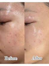 リラ 郡山店(Lilas)/内側から潤う水光肌に☆