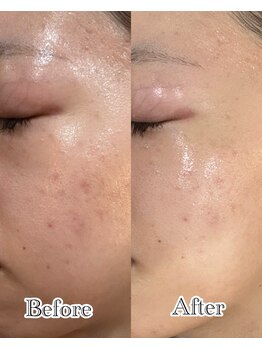 リラ 郡山店(Lilas)/内側から潤う水光肌に☆