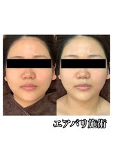 美バリサロン &nbsp;天神店/エアバリフェイシャル