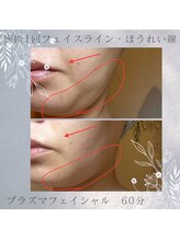 ビーメイクス(B・Makes)/プラズマ小顔フェイシャル