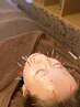 【2回目以降こちら】煌めき「AIKOKO」プレミアム美容鍼　12,000円