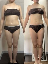 サロンドココ(Salon de COCO)/ハイパーナイフ全身痩身