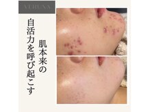 ココ 2号店(CoCo)の雰囲気（根本改善を目指すならVERUNAハーブピーリング一択）