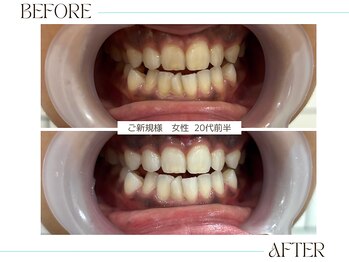 ホワイトニングサロンブライト 尼崎店(Whitening salon bright)/今年中にホワイトニングを!!!
