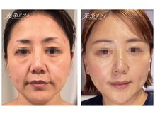 ラトワ(LATOWA)/光糸リフトビフォーアフター